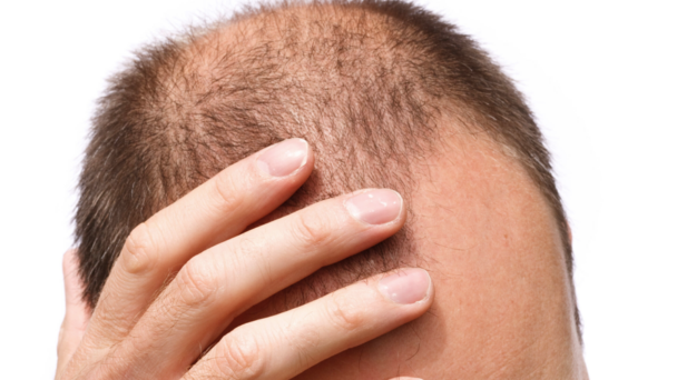 la-cura-contra-la-calvicie-podria-ser-una-realidad-con-una-nueva-molecula la-cura-contra-la-calvicie-podria-ser-una-realidad-con-una-nueva-molecula
