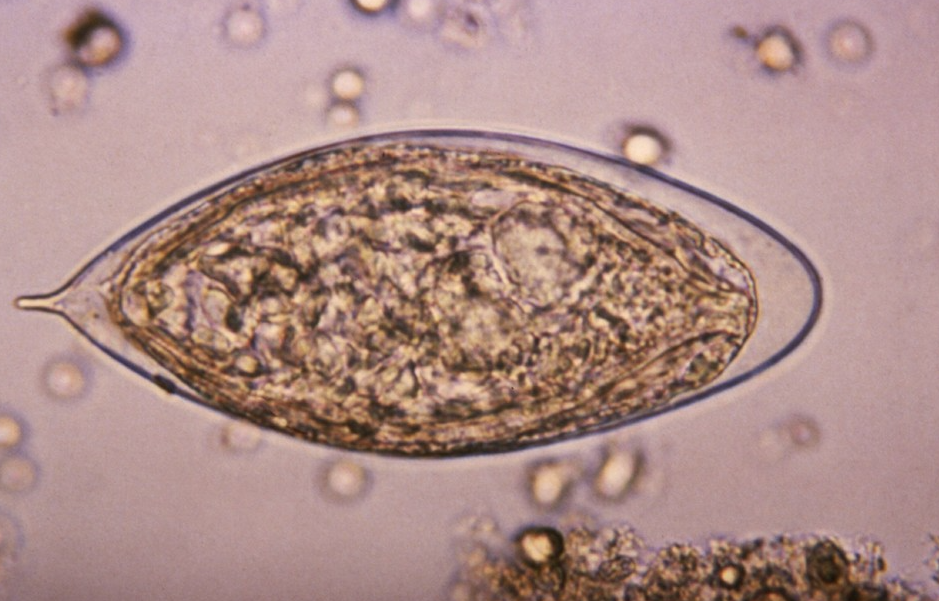 una-infeccion-a-menudo-ignorada-podria-aumentar-el-riesgo-de-cancer una-infeccion-a-menudo-ignorada-podria-aumentar-el-riesgo-de-cancer