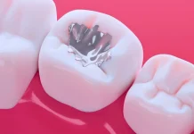 Estados acuerdan poner fin a las amalgamas dentales con mercurio en 2034 estados-acuerdan-poner-fin-a-las-amalgamas-dentales-con-mercurio-en-2034