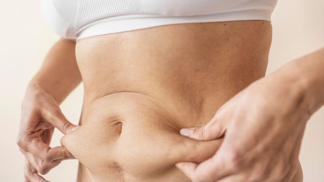 flacidez-cutanea-despues-de-perder-peso:-las-opciones-mas-efectivas-para-recuperar-la-firmeza flacidez-cutanea-despues-de-perder-peso:-las-opciones-mas-efectivas-para-recuperar-la-firmeza