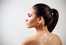 Manchas blancas en la piel: origen, riesgos y la importancia de una evaluación profesional manchas-blancas-en-la-piel:-origen,-riesgos-y-la-importancia-de-una-evaluacion-profesional