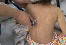 Alerta de la OMS: retorno de la transmisión endémica del sarampión en España alerta-de-la-oms:-retorno-de-la-transmision-endemica-del-sarampion-en-espana