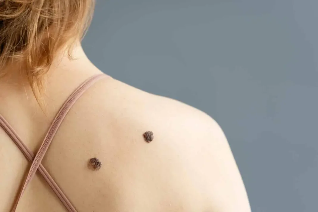 suplemento-de-vitamina-b3-podria-reducir-el-riesgo-de-cancer-de-piel-no-melanoma