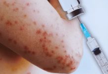 Alerta en Nueva York: Por brote de sarampión alerta-en-nueva-york:-por-brote-de-sarampion