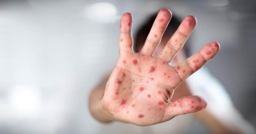 mexico-supera-los-10.000-casos-de-sarampion-en-un-brote-que-ha-provocado-31-fallecidos