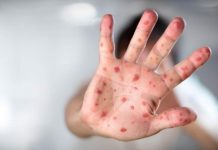 México supera los 10.000 casos de sarampión en un brote que ha provocado 31 fallecidos mexico-supera-los-10.000-casos-de-sarampion-en-un-brote-que-ha-provocado-31-fallecidos