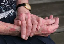 Chile, primer país de América libre de lepra según la OMS chile,-primer-pais-de-america-libre-de-lepra-segun-la-oms