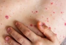 Mpox llega a Nueva York: conoce los síntomas y cómo se transmite mpox-llega-a-nueva-york:-conoce-los-sintomas-y-como-se-transmite