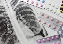 Especialistas alertan: la diabetes aumenta gravedad y mortalidad de la tuberculosis especialistas-alertan:-la-diabetes-aumenta-gravedad-y-mortalidad-de-la-tuberculosis