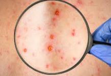 Sarampión y varicela: cómo diferenciar sus síntomas sarampion-y-varicela:-como-diferenciar-sus-sintomas